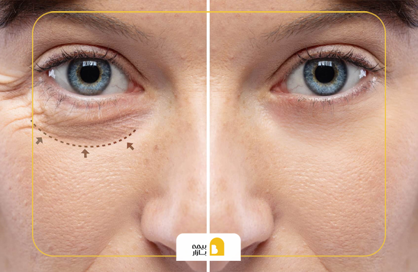 هزینه عمل افتادگی پلک با و بدون بیمه تکمیلی