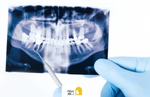 هزینه عکس دندان با بیمه تکمیلی و بیمه تامین اجتماعی